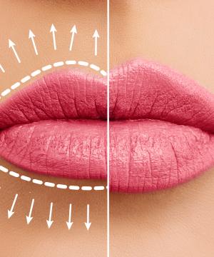 Lip Fillers Near Me  in Winter Park, FL