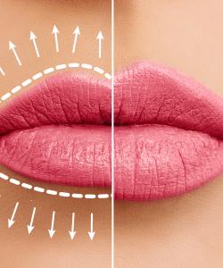 Lip Fillers Near Me  in Winter Park, FL